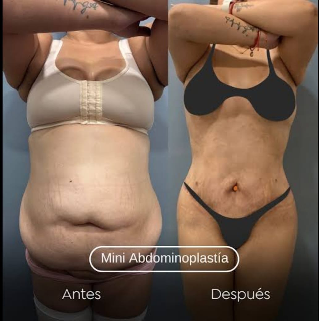 Miniabdominoplastia
